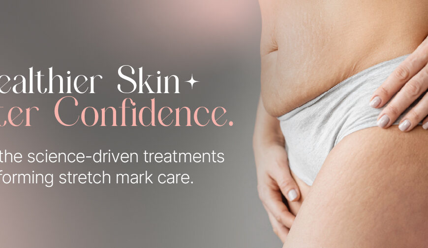 Stretch Mark Removal: What Actually Works, From RF Microneedling to Laser